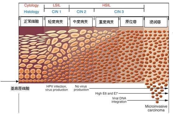 宫颈病变二级离癌多远,宫颈高级病变3级属于癌吗