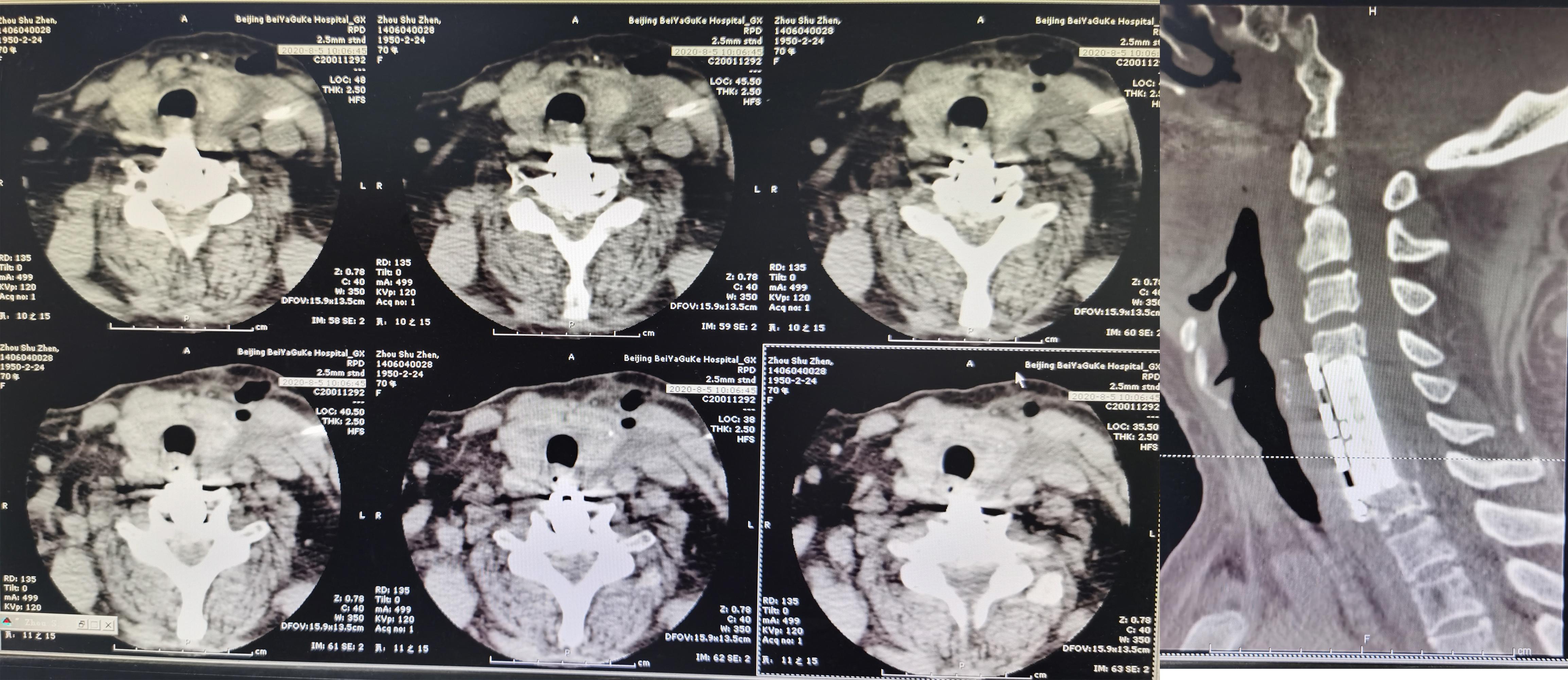 颈椎术后脑脊液漏取什么体位,脊髓型颈椎病手术后植骨愈合时间