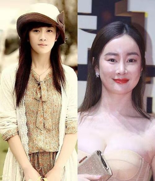 张檬取出假体颜值重回巅峰,张檬取出假体颜值重回巅峰照片