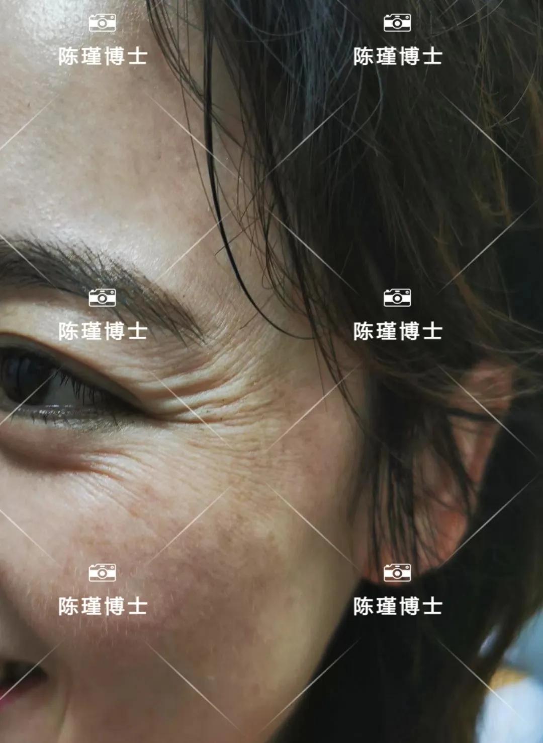 40岁女人皱纹越来越多显老态,40岁女人去皱纹最好的方法