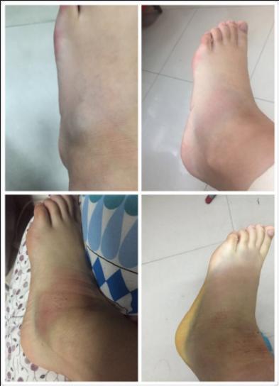 脚踝扭伤在深圳哪家医院比较好,脚踝扭伤哪个医院最好