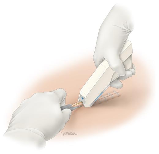 手术刀口上有订书钉怎么回事,手术伤口为什么要用订书针缝线