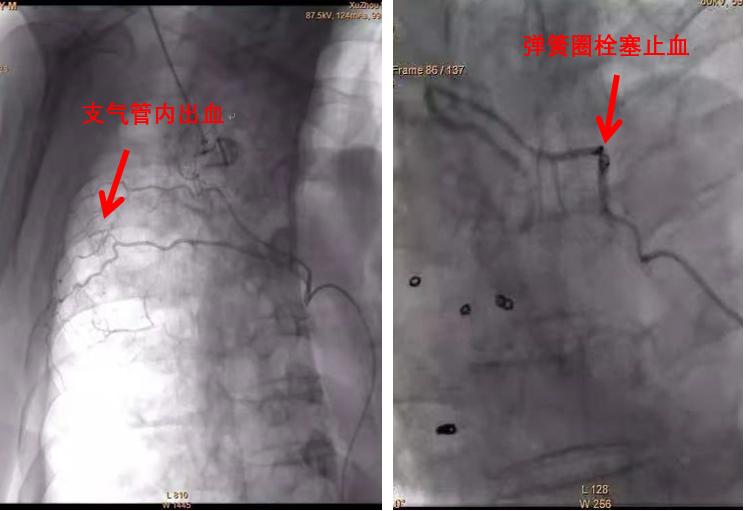 介入不放支架可以吗,介入放支架治标不治本