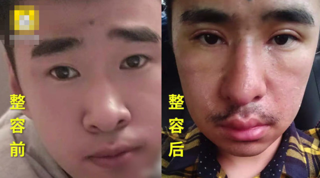 小伙花八十万整容整残,男子长相极度自卑花1600万整容