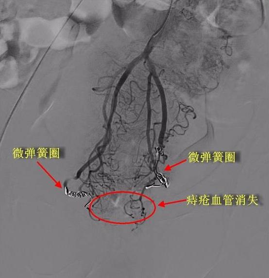 便血尿血怎么办,便血就医