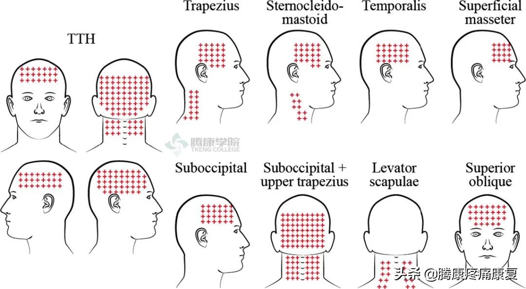 紧张性头痛如何治疗视频,紧张性头痛的临床表现及诊断