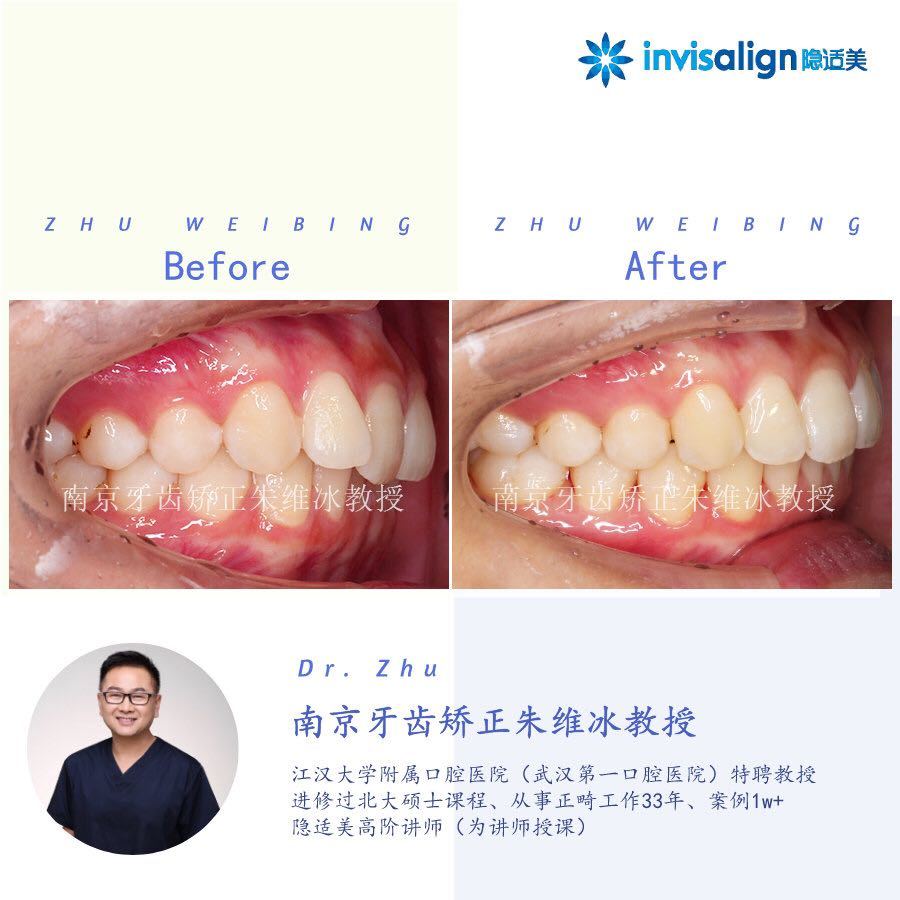 南京口腔医院矫正一颗牙齿多少钱,大医院为啥不建议做牙齿矫正