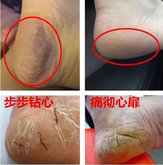 年年入冬脚就干裂有什么方法治好,想长寿养好背