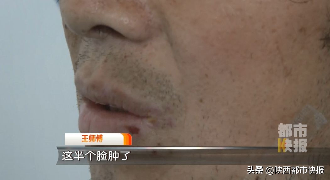 男子牙疼出脓液,男子牙疼去医院检查发现虫子