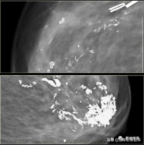 乳腺钙化怎么区分良性和恶性,乳腺钙化的诊断与分级