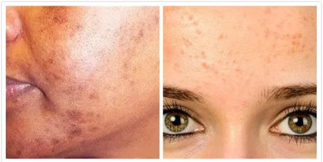 常见的色斑种类图文,脸部常见斑种类及图片