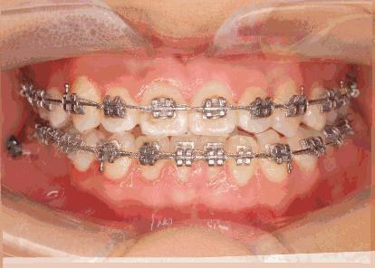 做牙套的工资一般多少,戴个牙套有什么用