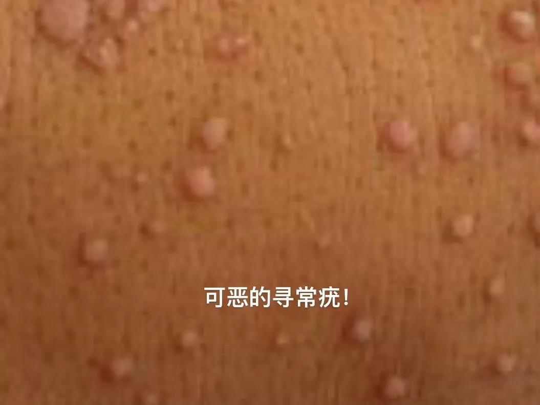 hpv每个女人都会经历么,hpv伤害性有多大