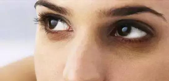 祛除大眼袋黑眼圈皱纹色斑痘痘,怎样祛除黑眼圈眼袋的方法