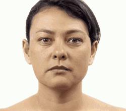 除皱医美项目,医美除皱最佳的方法是哪个