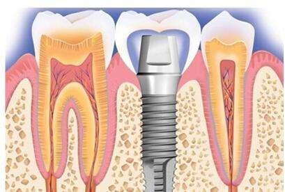 大牙拔了是镶牙还是种牙合适,拔六龄牙会不会伤到神经
