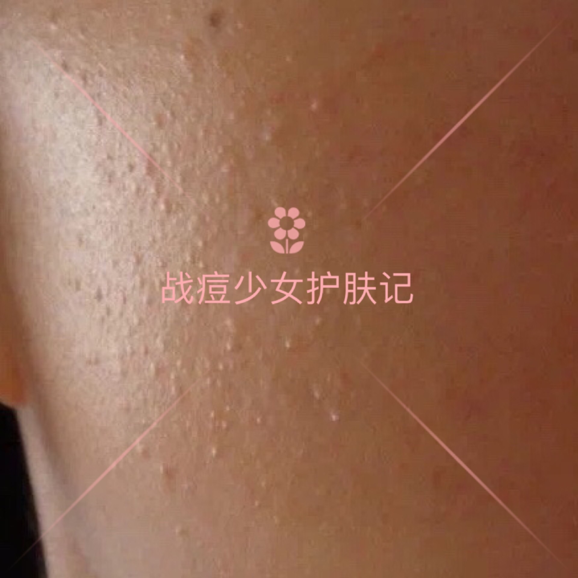 四招解决痘痘及痘痘的成因,痘痘不同原因类型及处理方法