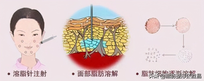 打了溶脂针可以吸脂吗,打完溶脂针还可以吸脂吗