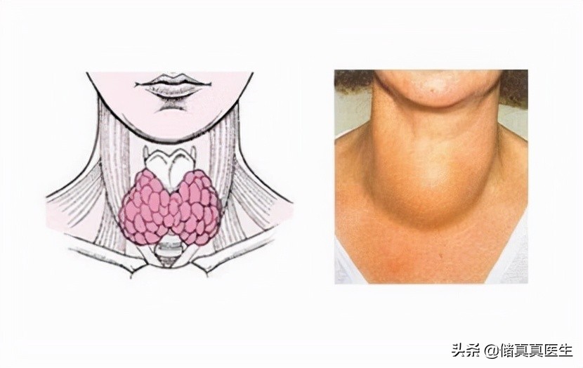 有了甲状腺结节该如何处理,有甲状腺结节怎么办教你三个动作