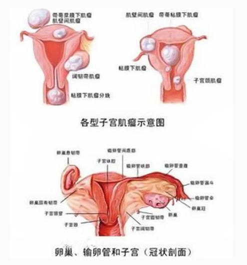 桂枝茯苓丸治疗子宫肌瘤,桂枝茯苓丸治疗子宫肌瘤原理