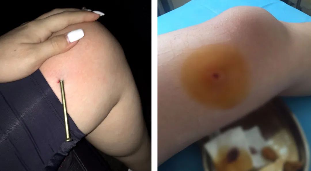 三岁女童手指被压断后续,小孩手指被夹伤需要多久才能恢复