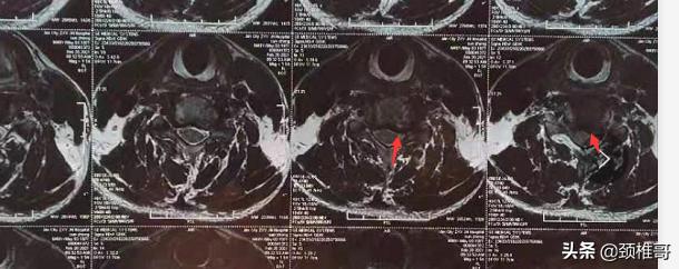 打篮球被撞胸口动一下就疼没有肿,打篮球被撞得锁骨一边疼