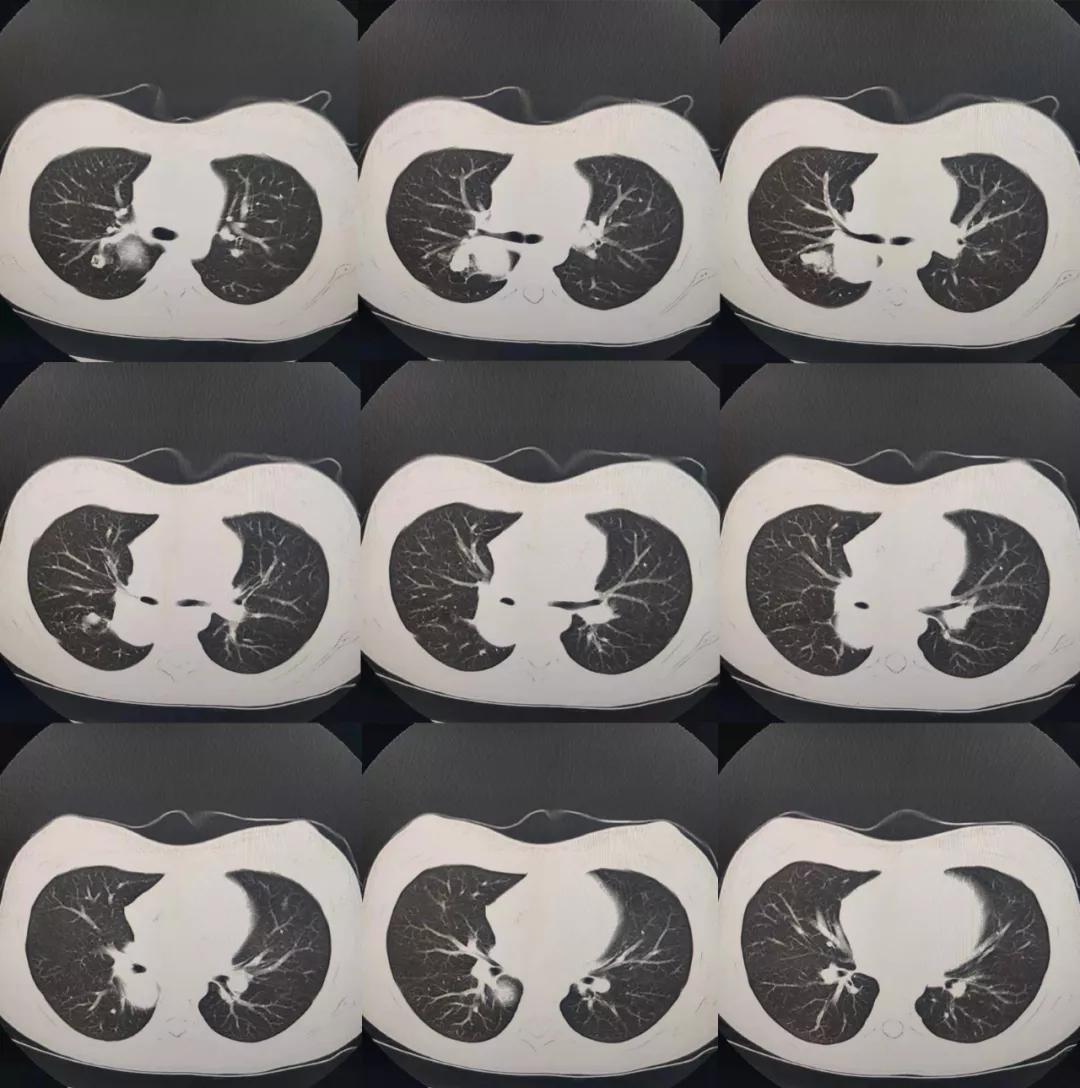 肺内见多发小囊状无纹理透光影,肺内肿块并厚壁空洞