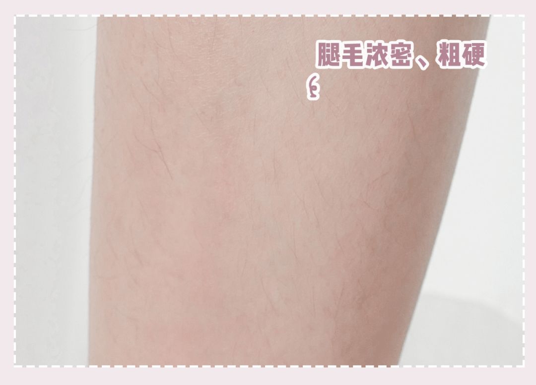 体毛脱毛的效果怎么样,天生体毛旺盛的人正常吗