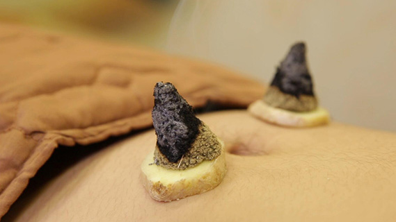 喵医生中医科普之冬病夏治の艾灸