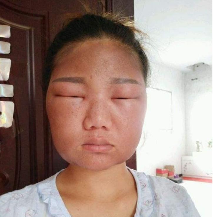 美容针变“毒针”，19岁女孩被毁容，医生：打针有风险跟风需谨慎