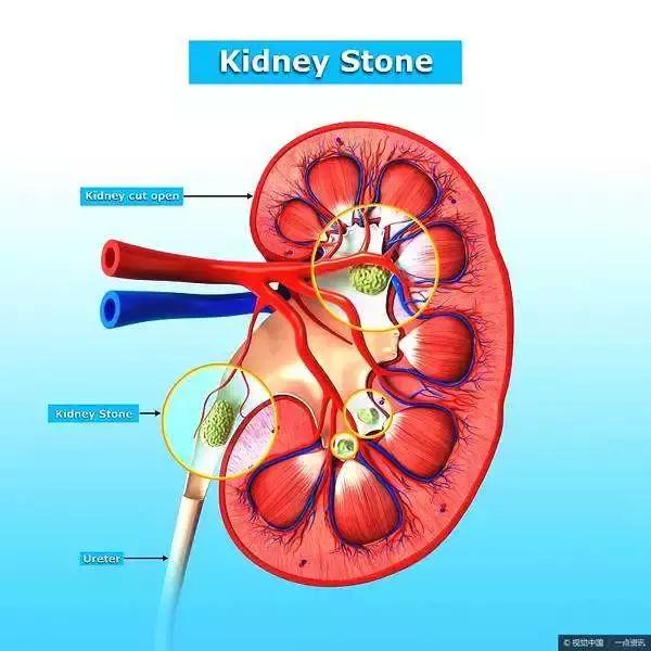 你尿中结晶体多是因为你不知道这些事，早掌握就早规避风险