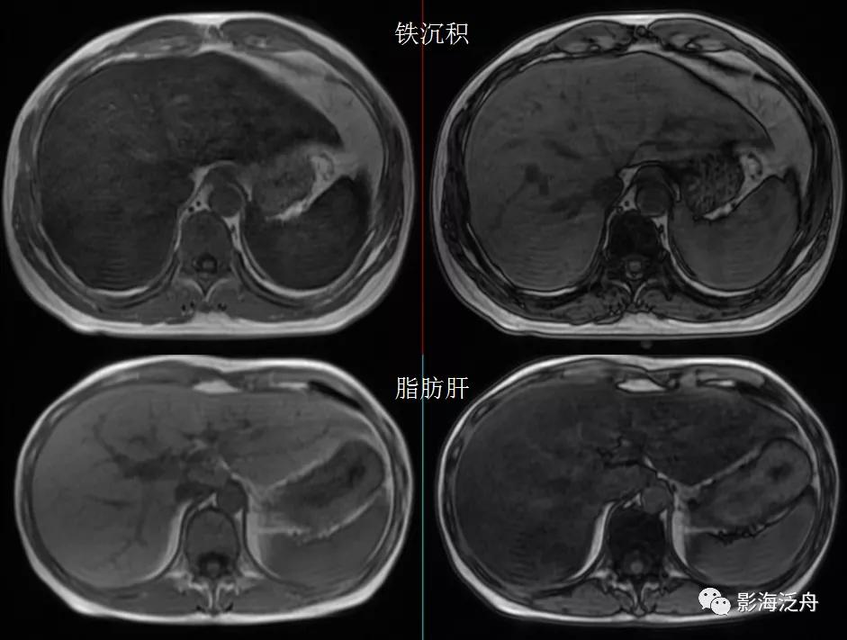 肝脏弥漫性病变严重吗,肝脏弥漫性的病变的症状