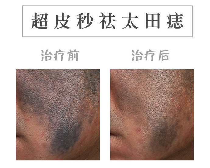 皮秒太田痣激光恢复过程,治疗太田痣费用贵吗