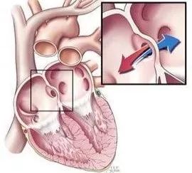 心脏的洞,心脏洞修补好还是封堵好