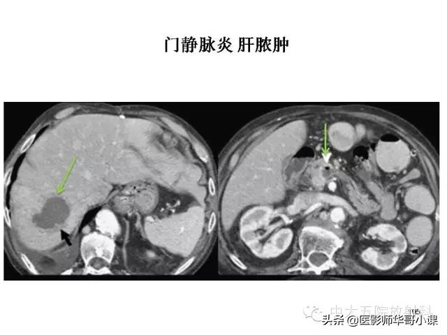 阑尾炎课件,阑尾炎的超声课件