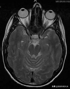 脑出血几年以后复发,脑出血几年后偏瘫越来越严重