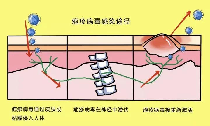 嘴唇长泡引起溃烂,嘴唇上火起水泡和疱疹区别