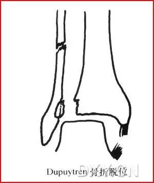 特殊骨折类型,特殊骨折体征