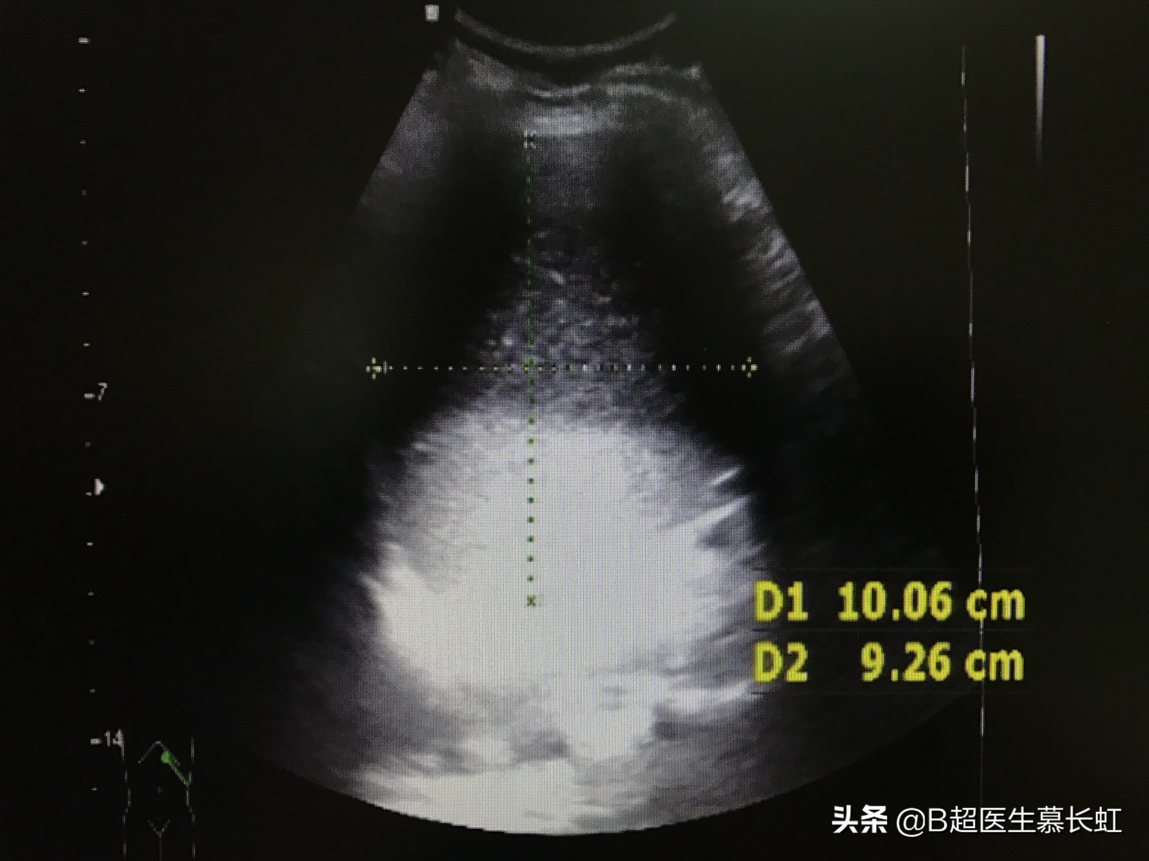 结石山楂可以吃吗,山楂容易长结石吗