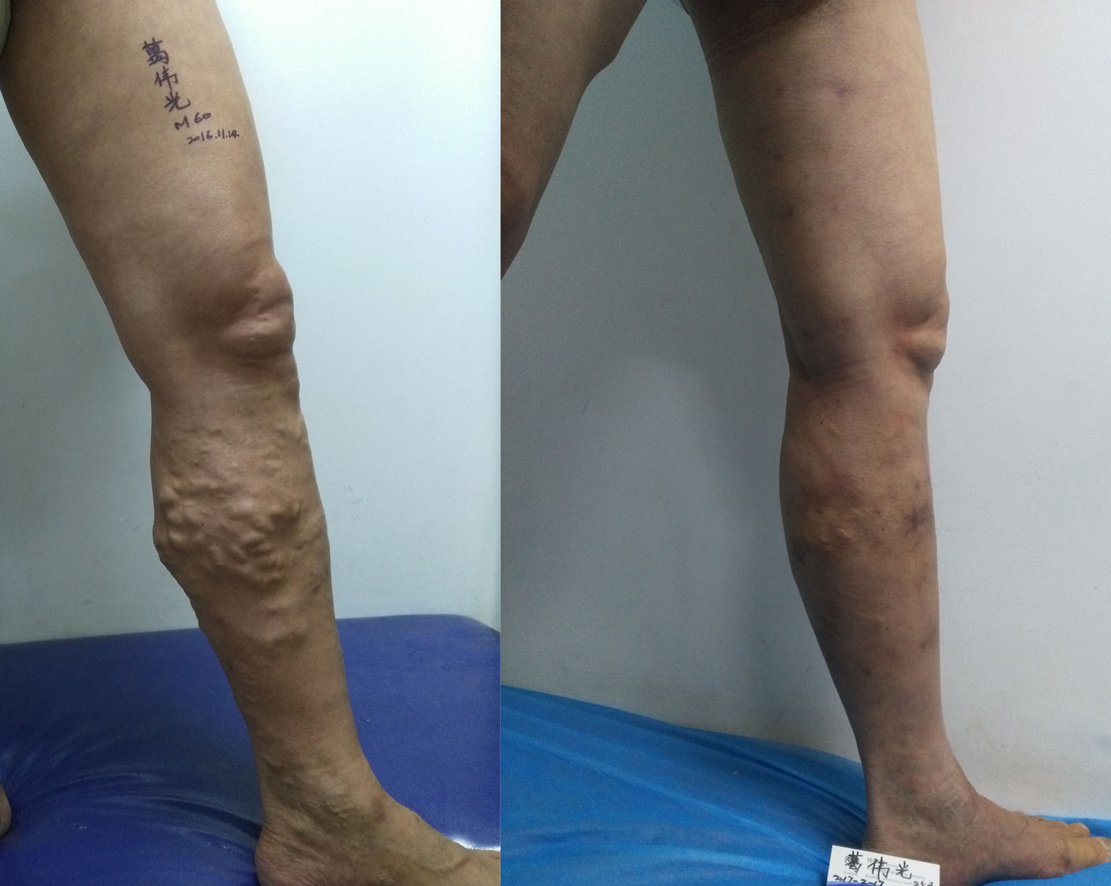 静脉曲张用什么药有效,静脉曲张怎么治疗效果最好呢