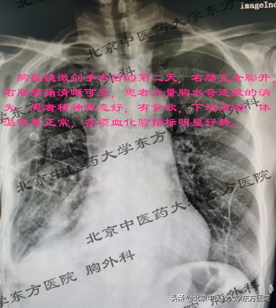 北京治疗胸腔积液哪个医院权威,中医治疗心脏胸腔积液