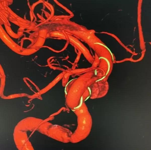 山东大学齐鲁医院王东海教授团队成功治疗多发性动脉瘤