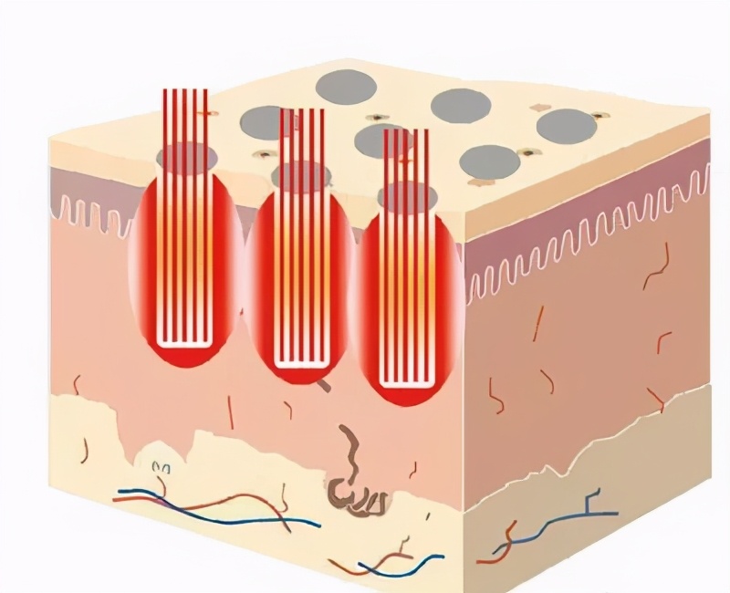 毛孔粗大痘痘粉刺统统搞定,暗沉粗糙毛孔粗大全部搞定