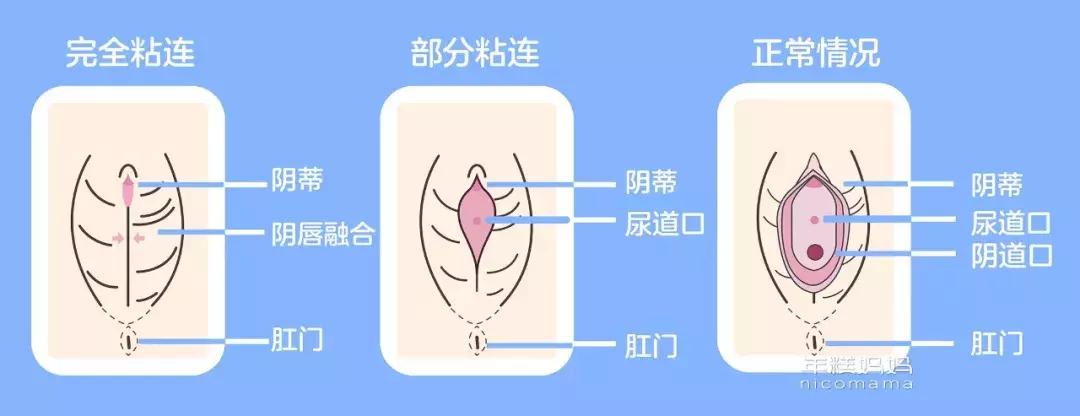 3周岁女宝宝外阴炎用什么药,女宝宝患阴道炎的表现
