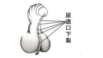 尿道下裂是一种怎么样的畸形？如何正确认识尿道下裂