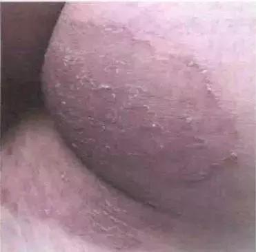 治疗真菌性皮肤病的中药方子,真菌皮肤病的书籍