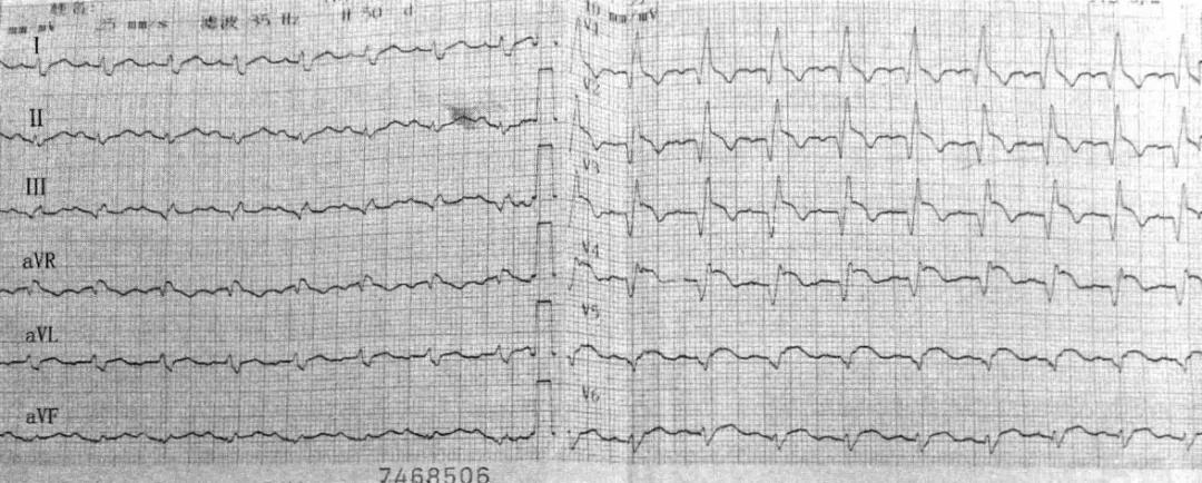 急性心梗合并心源性休克治疗原则,心梗引起心律失常