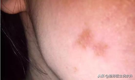 打溶脂针后悔,打溶脂针后悔一辈子