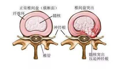 腰间盘突出脚麻腰疼怎么解决,腰间盘突出腰疼的不能动怎么办