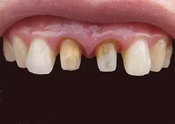 烤瓷牙崩瓷露出里面金属有毒吗,钛合金烤瓷牙有毒吗